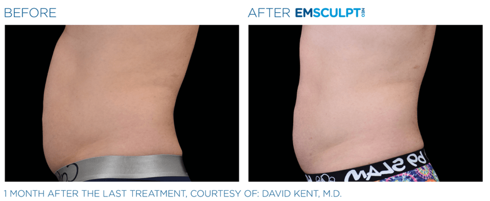 emsculpt neo before & after at avie medspa in leesburg, va 2