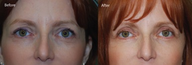 Eyelid Lifts at AVIE! provide beautiful results!