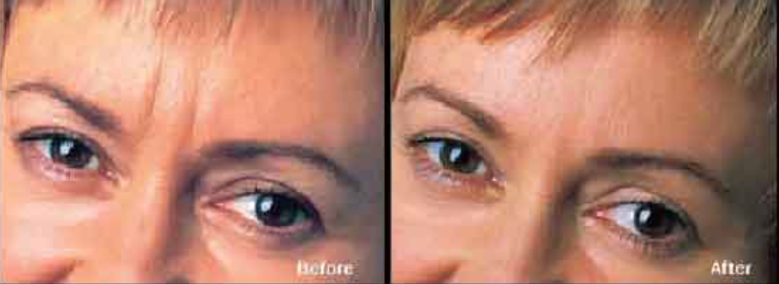 Dysport Before and After photo at AVIE! Medspa and Laser Center in Leesburg, VA.