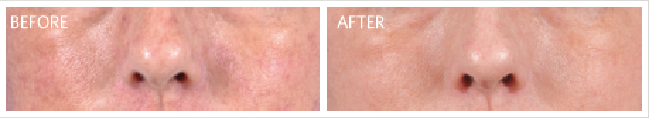 Before and after picture from AVIE! Medspa's Skin Care Boot Camp!