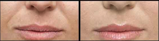 Before and After of dermal fillers for smile lines in Leesburg, VA at AVIE! Medspa and Laser Center.