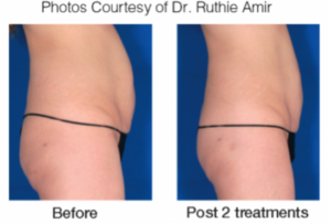 Experience the "latest and greatest" in body contouring with VelaShape at AVIE! MedSpa and Laser Center in Leesburg, Virginia!