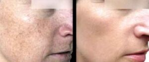 See amazing results with preventative treatments in Leesburg, VA!