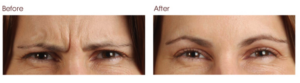 botox-before-and-after-avie-medspa-leesburg