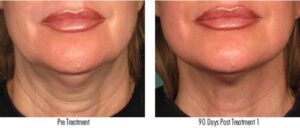 Ultherapy Before and After Leesburg Virginia Avie Medspa